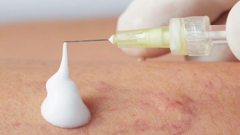 Insuficiencia venosa crónica: Es posible tratar las varices sin pasar por el quirófano?